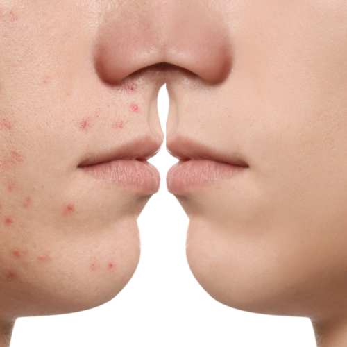 Acne Stop – Gesicht Behandlung