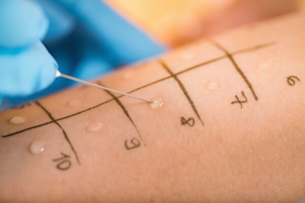 test-allergene-unterarm