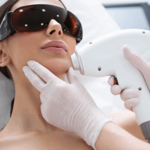 Dauerhafte Laser-Haarentfernung – Alma Soprano Titanium – Kinn oder Wangen