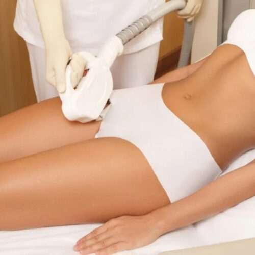 Dauerhafte Laser-Haarentfernung - Alma Soprano Titanium Bikini Zone